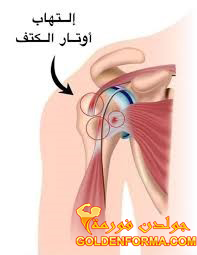 اصابات الكتف التهاب الأوتار