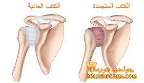 اصابات الكتف - الكتف المتجمدة