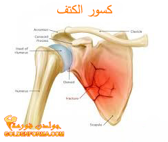 اصابات الكتف - الكسور