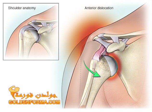 اصابات الكتف - خلع الكتف