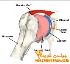 اصابات الكتف - قطع لابرال